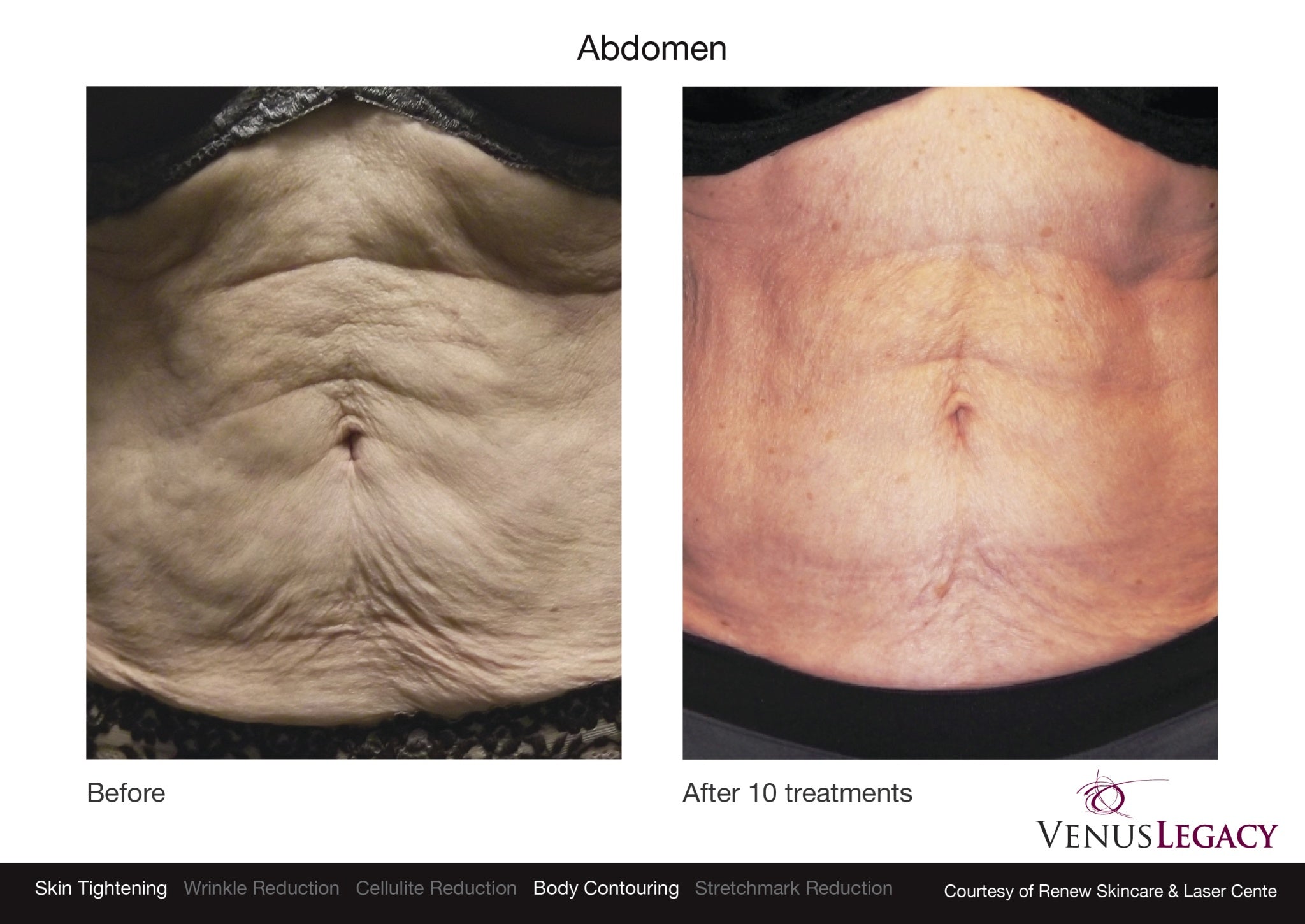 Venus Legacy Fat reduction Treatment