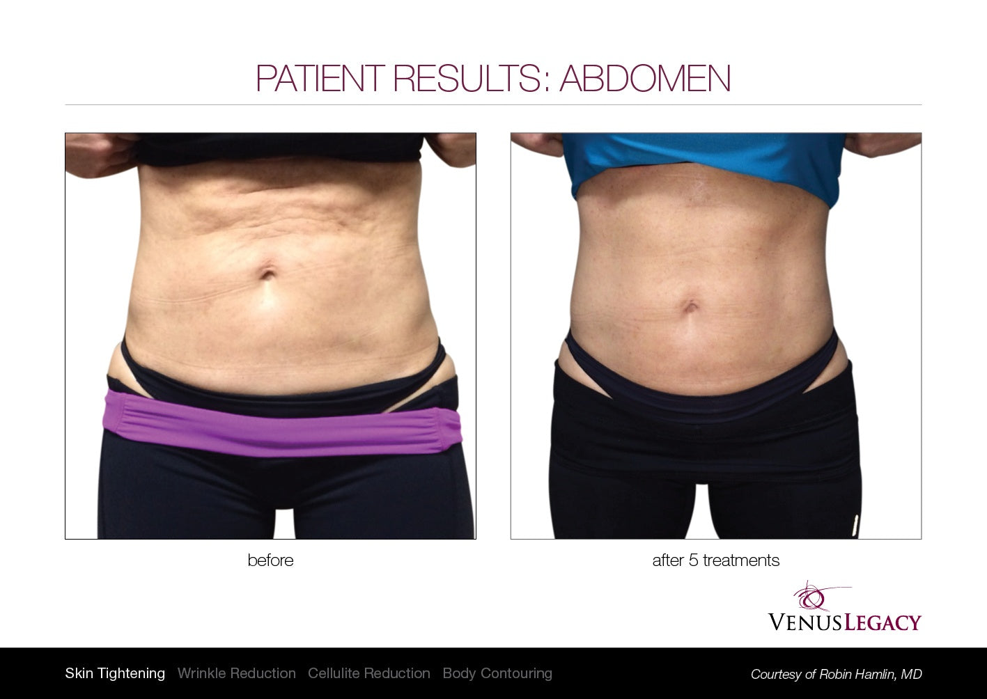 Venus Legacy Fat reduction Treatment