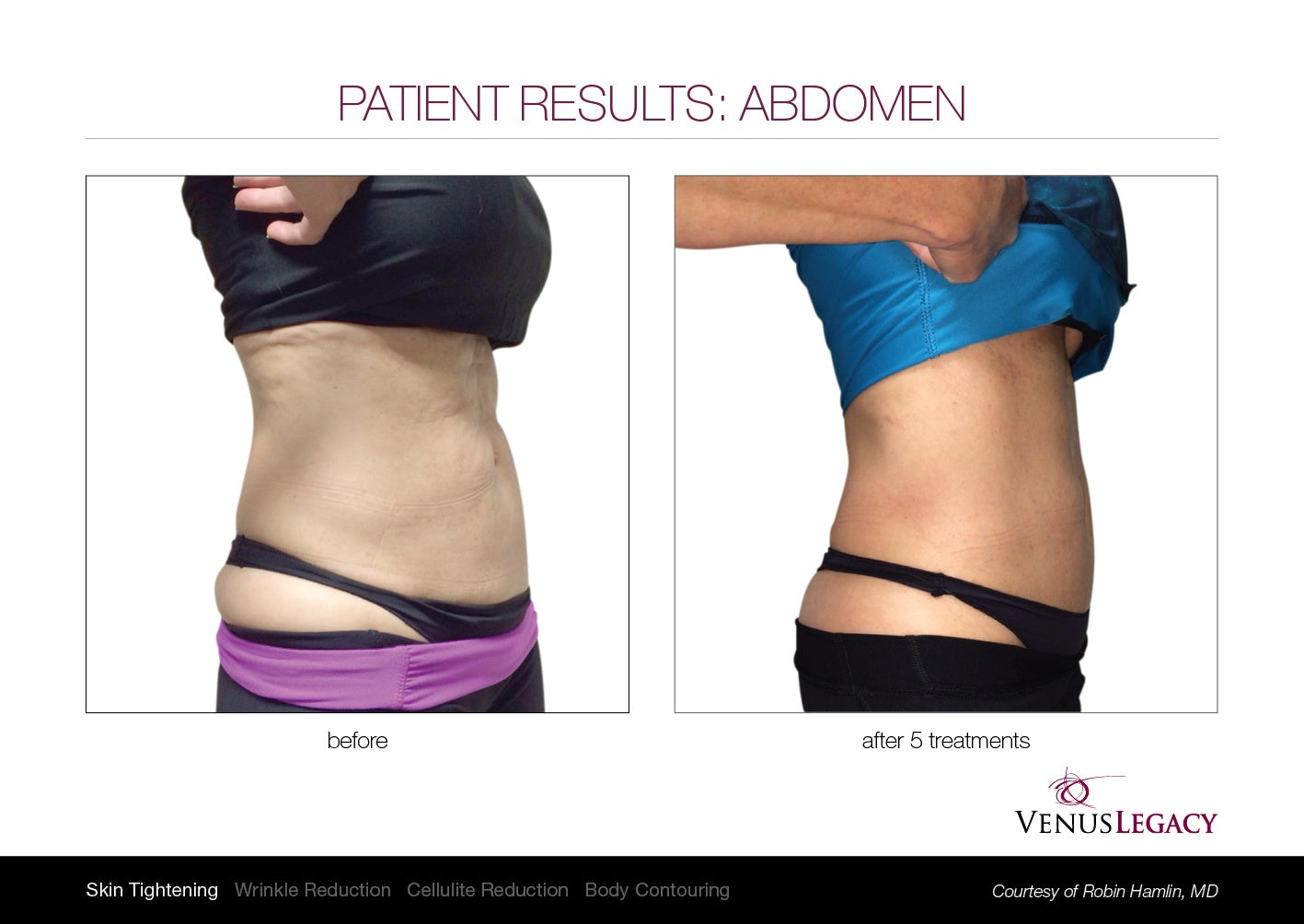 Venus Legacy Fat reduction Treatment